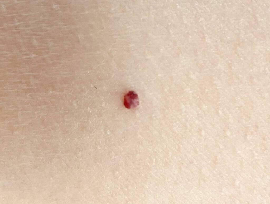 Hemangiomas