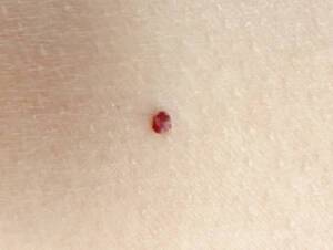 Cherry Hemangiomas